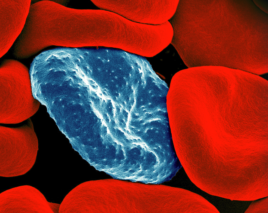 Red Blood Cell Infected with Malaria Parasites Colorized scanning electron micrograph of red blood cell infected with malaria parasites (blue). The small bumps on the infected cell show how the parasite remodels its host cell by forming protrusions called 'knobs' on the surface, enabling it to avoid destruction and cause inflammation. Uninfected cells (red) have smoother surfaces. Photo credit: National Institute of Allergy and Infectious Diseases (NIAID)