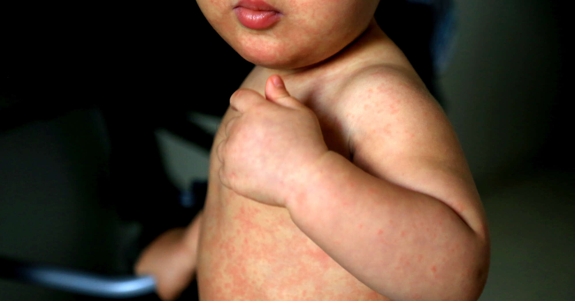 Image of SALVADOR, BAHIA / BRAZIL - February 14, 2017: Child with measles symptoms is seen with small red spots on body and feverish state.