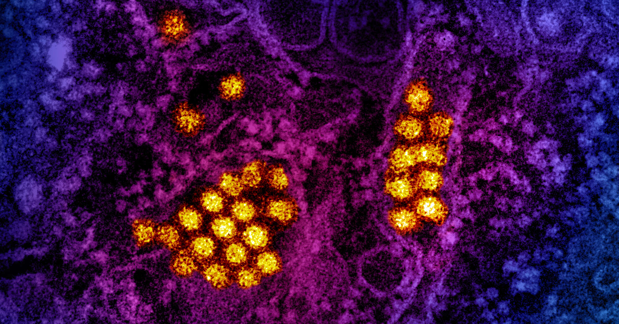ransmission electron micrograph of dengue virus particles (gold). Micrograph courtesy of CDC; colorization and visual effects by NIAID © CDC and NIAID