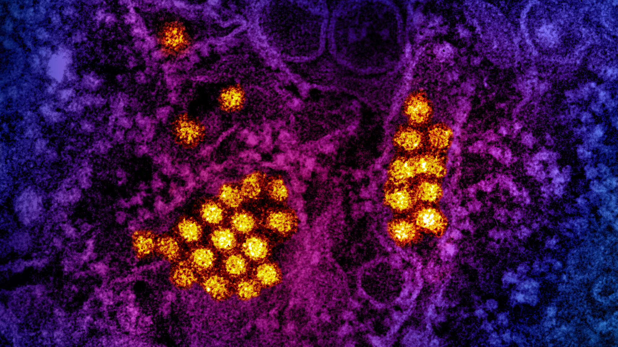 ransmission electron micrograph of dengue virus particles (gold). Micrograph courtesy of CDC; colorization and visual effects by NIAID © CDC and NIAID