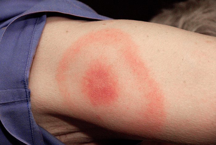 Lyme disease rash