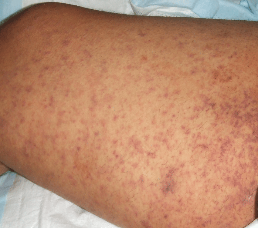 Petechial-rash-on-a-patient-with-Rocky-Mountain-spotted-fever-caused-by-Rickettsia