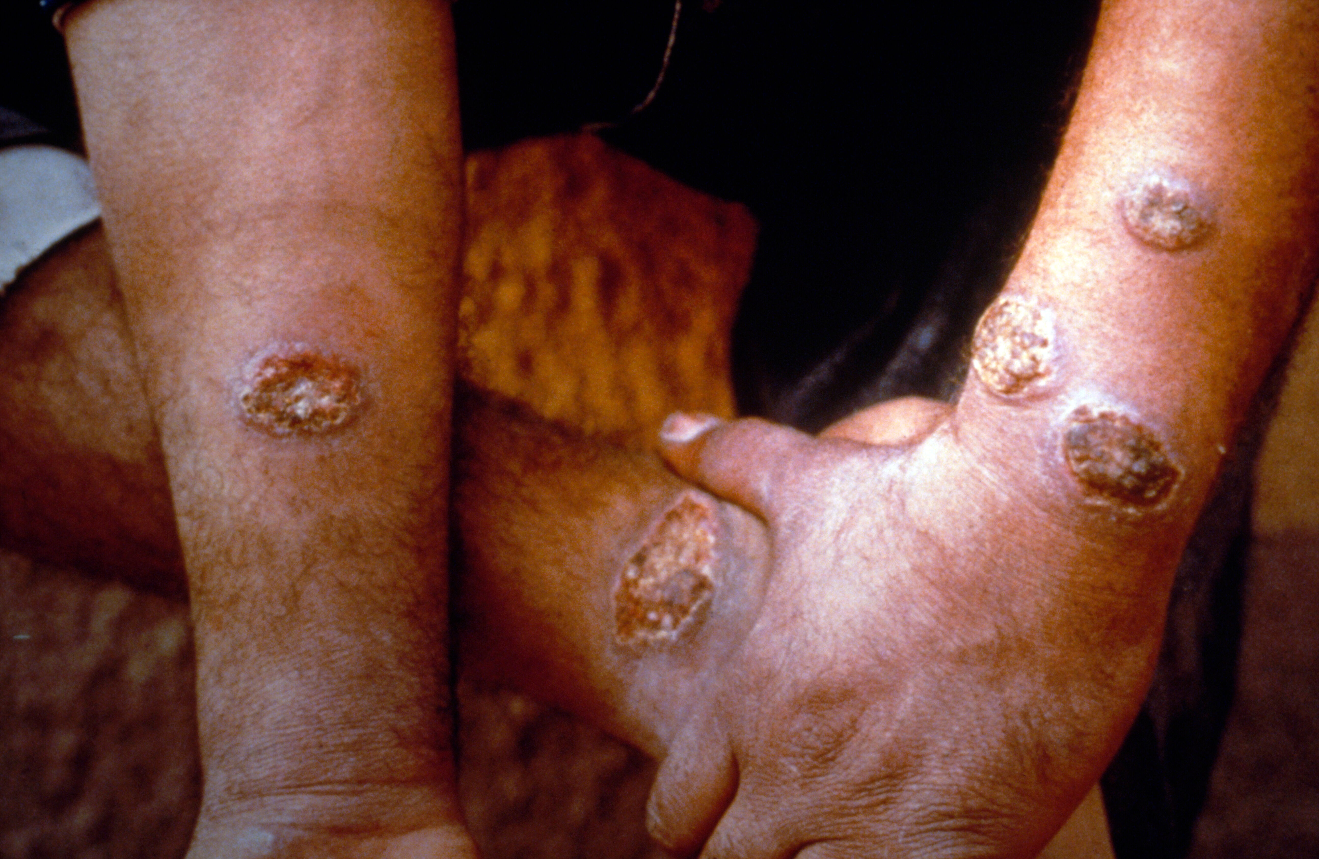 Cutaneous Lieshmaniasis